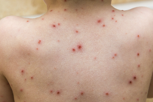Chicken pox rash on a child's back